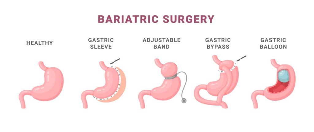 Bariatric Surgery